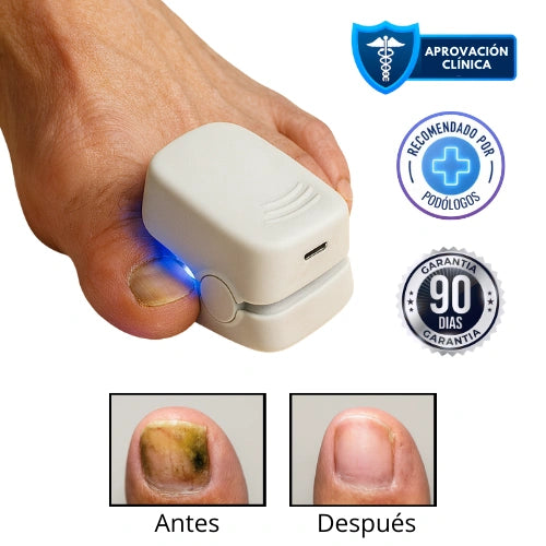 LumiNail Pro™ Elimina Hongos y Repara tus uñas