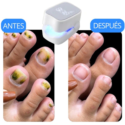 LumiNail Pro™ Elimina Hongos y Repara tus uñas