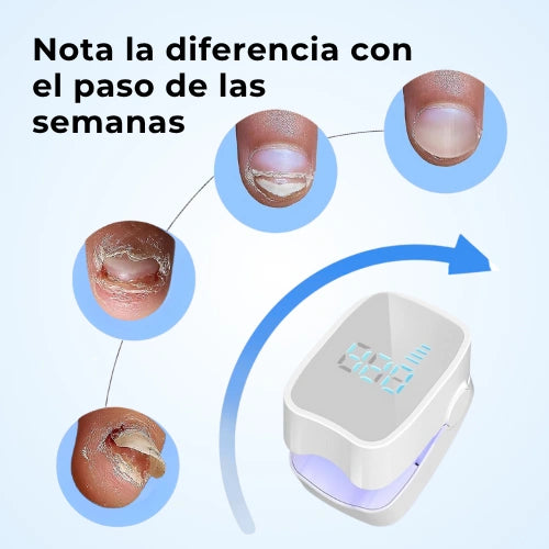 LumiNail Pro™ Elimina Hongos y Repara tus uñas